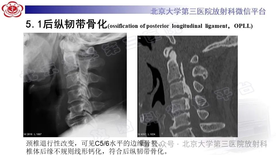 影像PPT - 【PPT】弥漫性特发性骨肥厚症-21