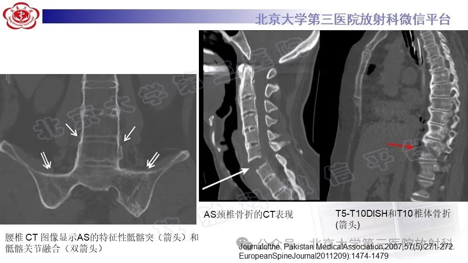 影像PPT - 【PPT】弥漫性特发性骨肥厚症-23