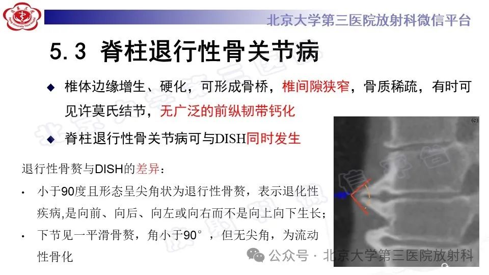 影像PPT - 【PPT】弥漫性特发性骨肥厚症-24