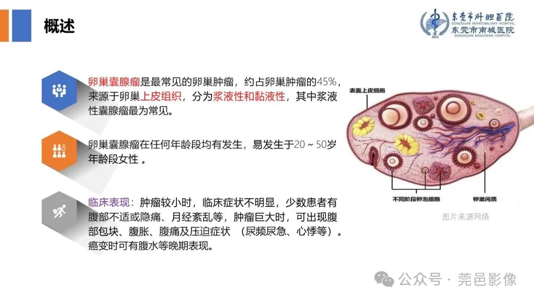 影像PPT - 【PPT】卵巢囊腺瘤MRI诊断与鉴别诊断-4