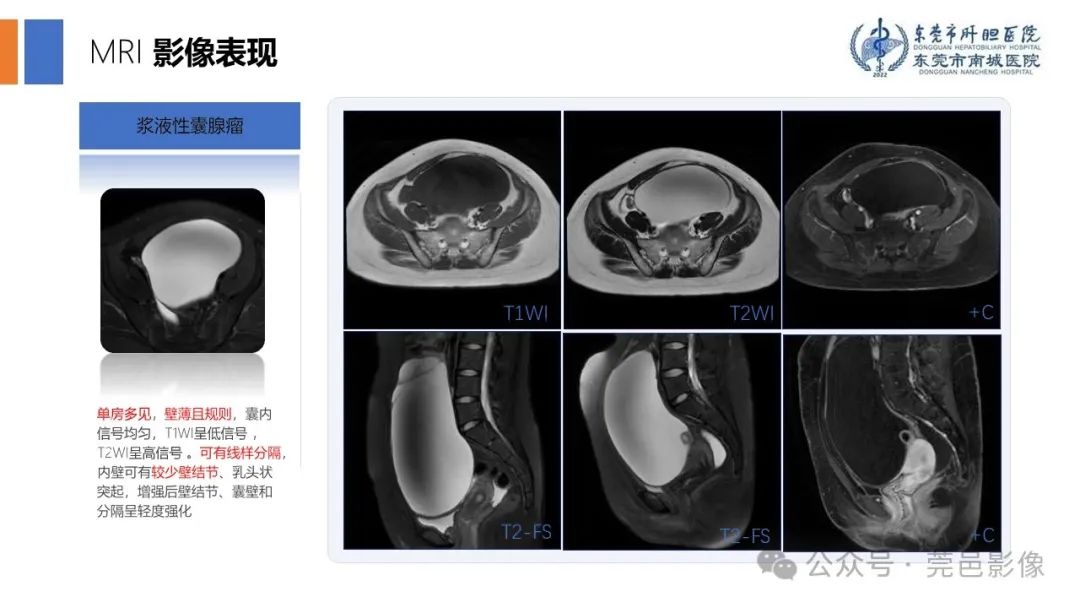 影像PPT - 【PPT】卵巢囊腺瘤MRI诊断与鉴别诊断-6