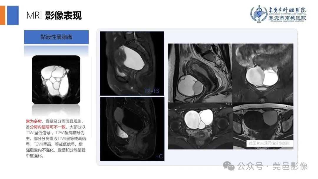 影像PPT - 【PPT】卵巢囊腺瘤MRI诊断与鉴别诊断-7
