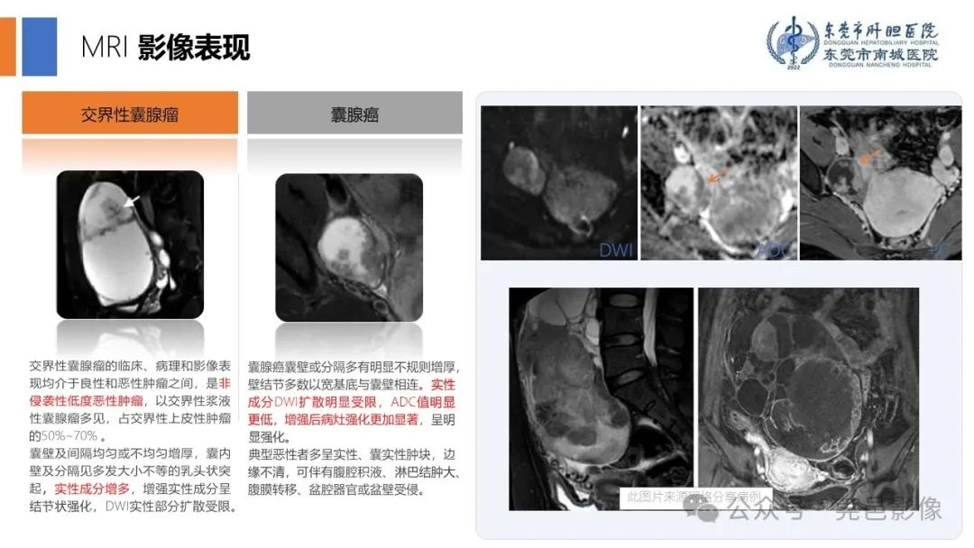 影像PPT - 【PPT】卵巢囊腺瘤MRI诊断与鉴别诊断-8