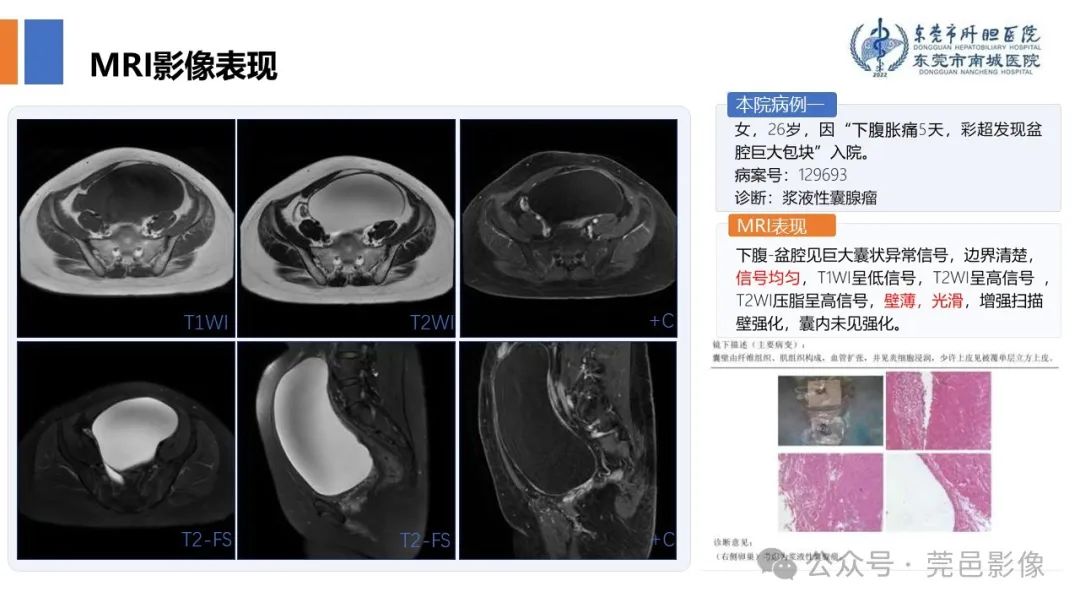 影像PPT - 【PPT】卵巢囊腺瘤MRI诊断与鉴别诊断-10