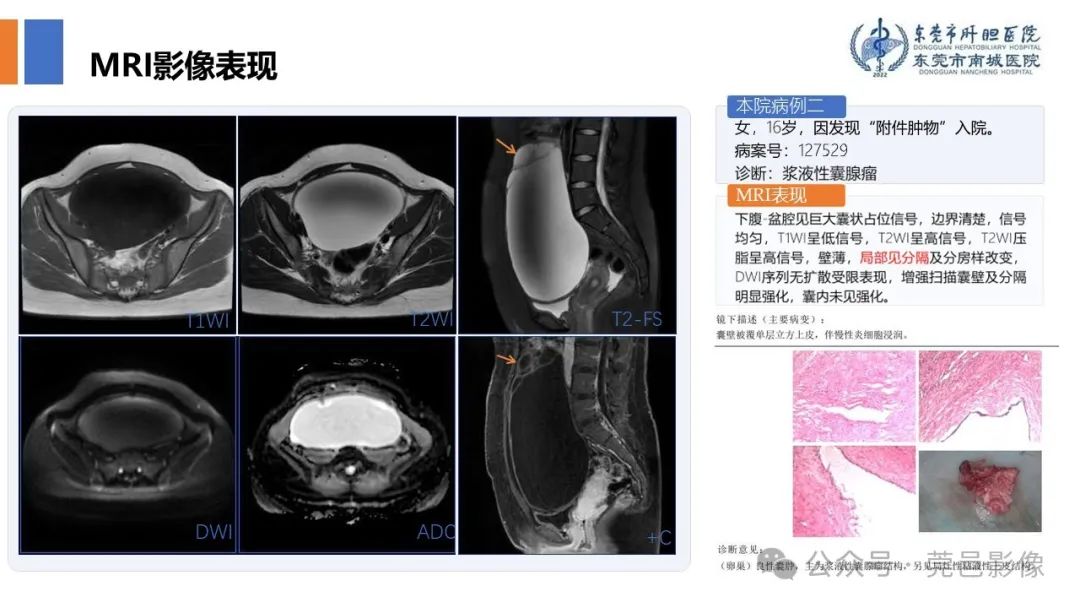 影像PPT - 【PPT】卵巢囊腺瘤MRI诊断与鉴别诊断-11