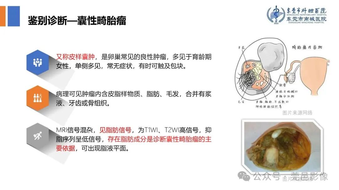 影像PPT - 【PPT】卵巢囊腺瘤MRI诊断与鉴别诊断-15