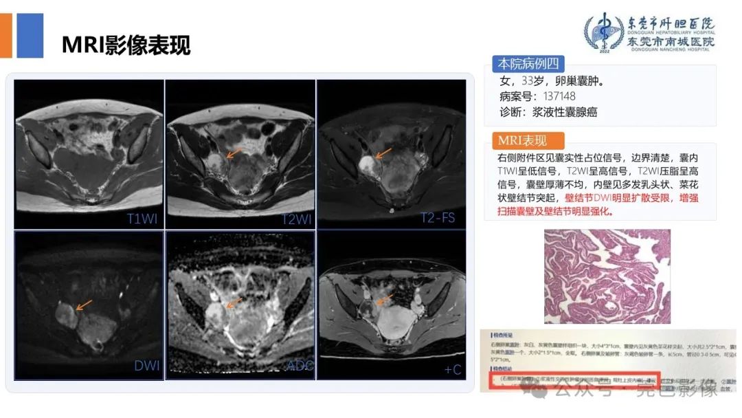 影像PPT - 【PPT】卵巢囊腺瘤MRI诊断与鉴别诊断-13