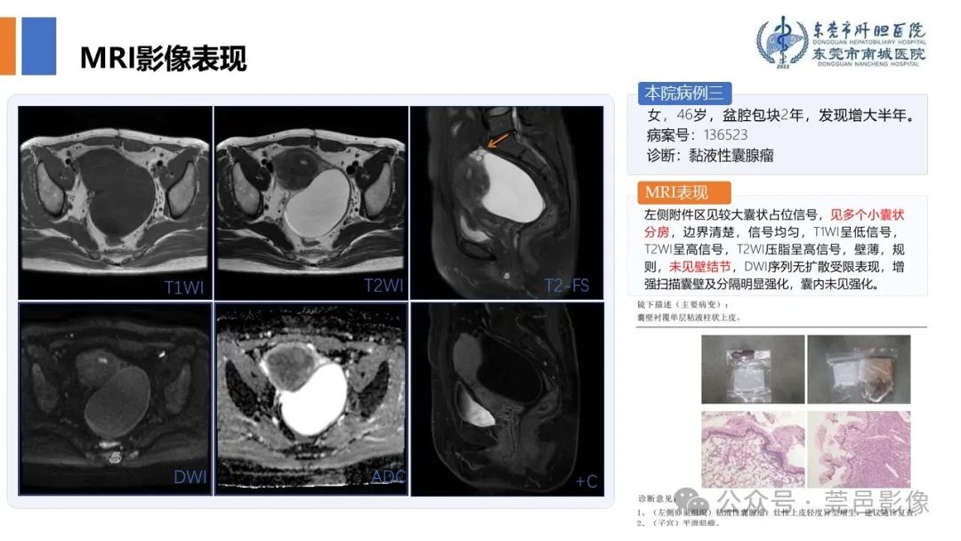 影像PPT - 【PPT】卵巢囊腺瘤MRI诊断与鉴别诊断-12