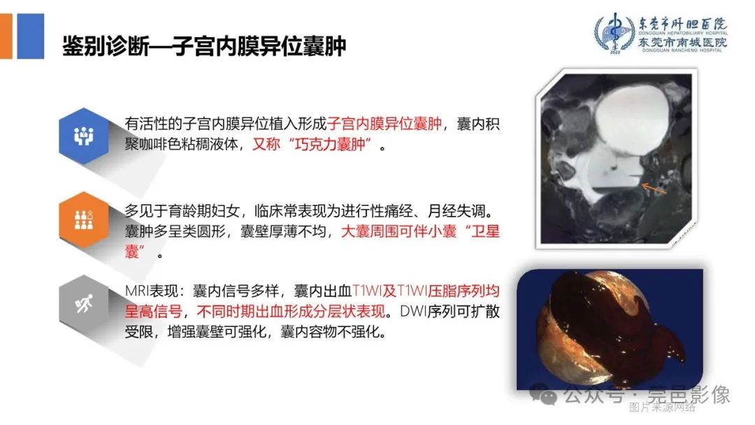 影像PPT - 【PPT】卵巢囊腺瘤MRI诊断与鉴别诊断-18