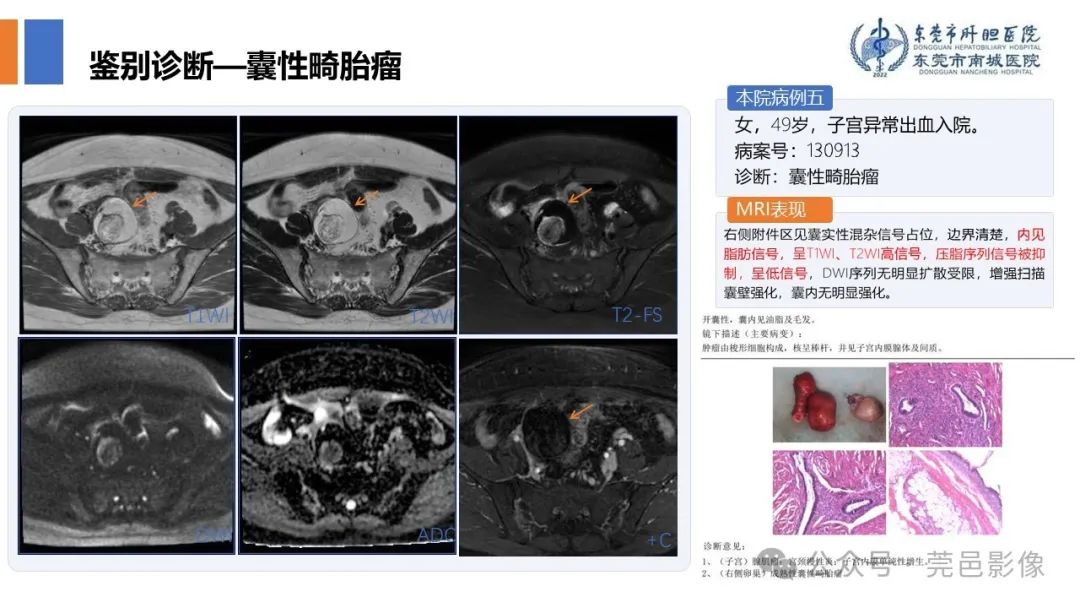 影像PPT - 【PPT】卵巢囊腺瘤MRI诊断与鉴别诊断-16