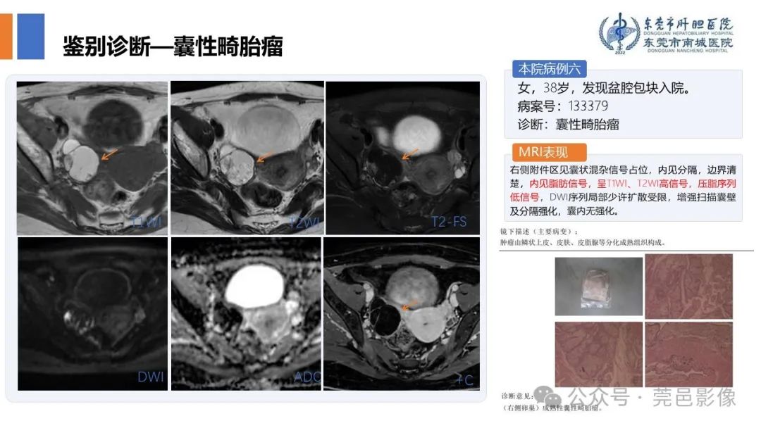 影像PPT - 【PPT】卵巢囊腺瘤MRI诊断与鉴别诊断-17