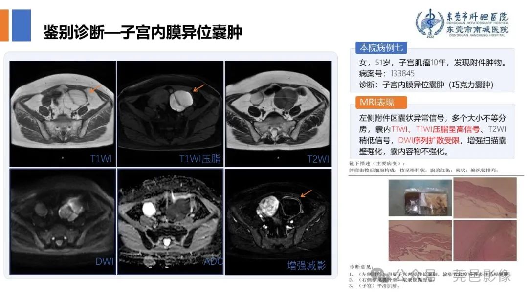 影像PPT - 【PPT】卵巢囊腺瘤MRI诊断与鉴别诊断-19