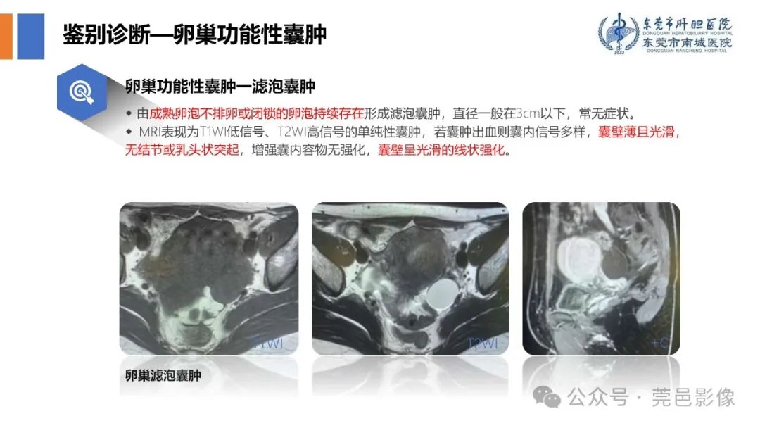 影像PPT - 【PPT】卵巢囊腺瘤MRI诊断与鉴别诊断-20