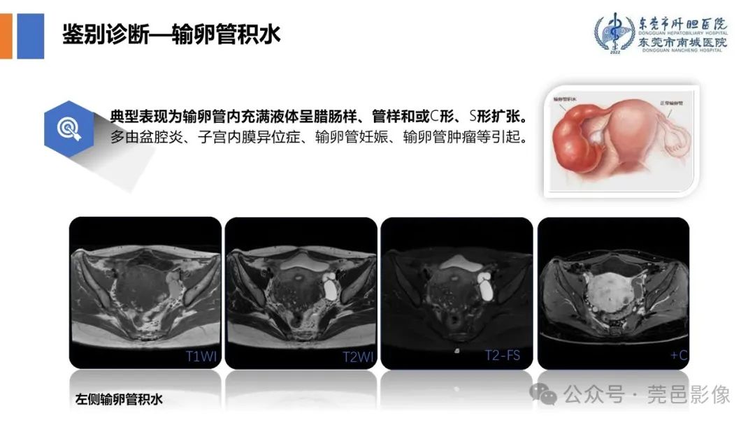 影像PPT - 【PPT】卵巢囊腺瘤MRI诊断与鉴别诊断-22