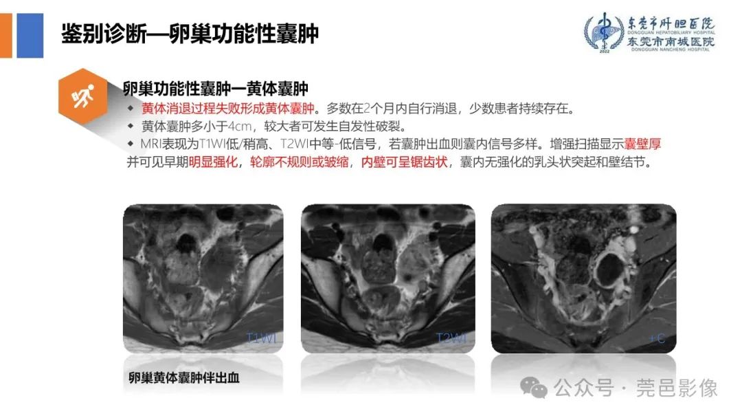 影像PPT - 【PPT】卵巢囊腺瘤MRI诊断与鉴别诊断-21
