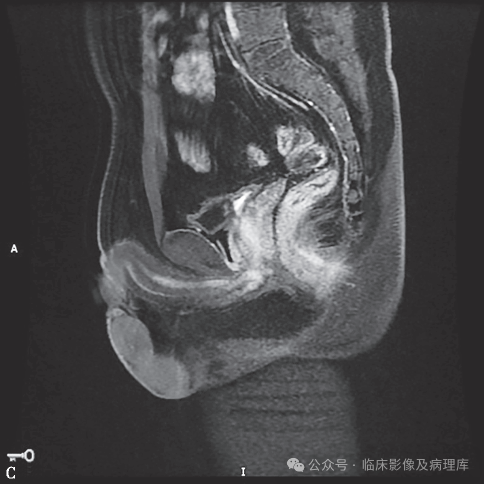 影像PPT - 肛周脓肿与肛瘘-4 影像PPT - 肛周脓肿与肛瘘-4