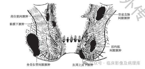 影像PPT - 肛周脓肿与肛瘘-2 影像PPT - 肛周脓肿与肛瘘-2