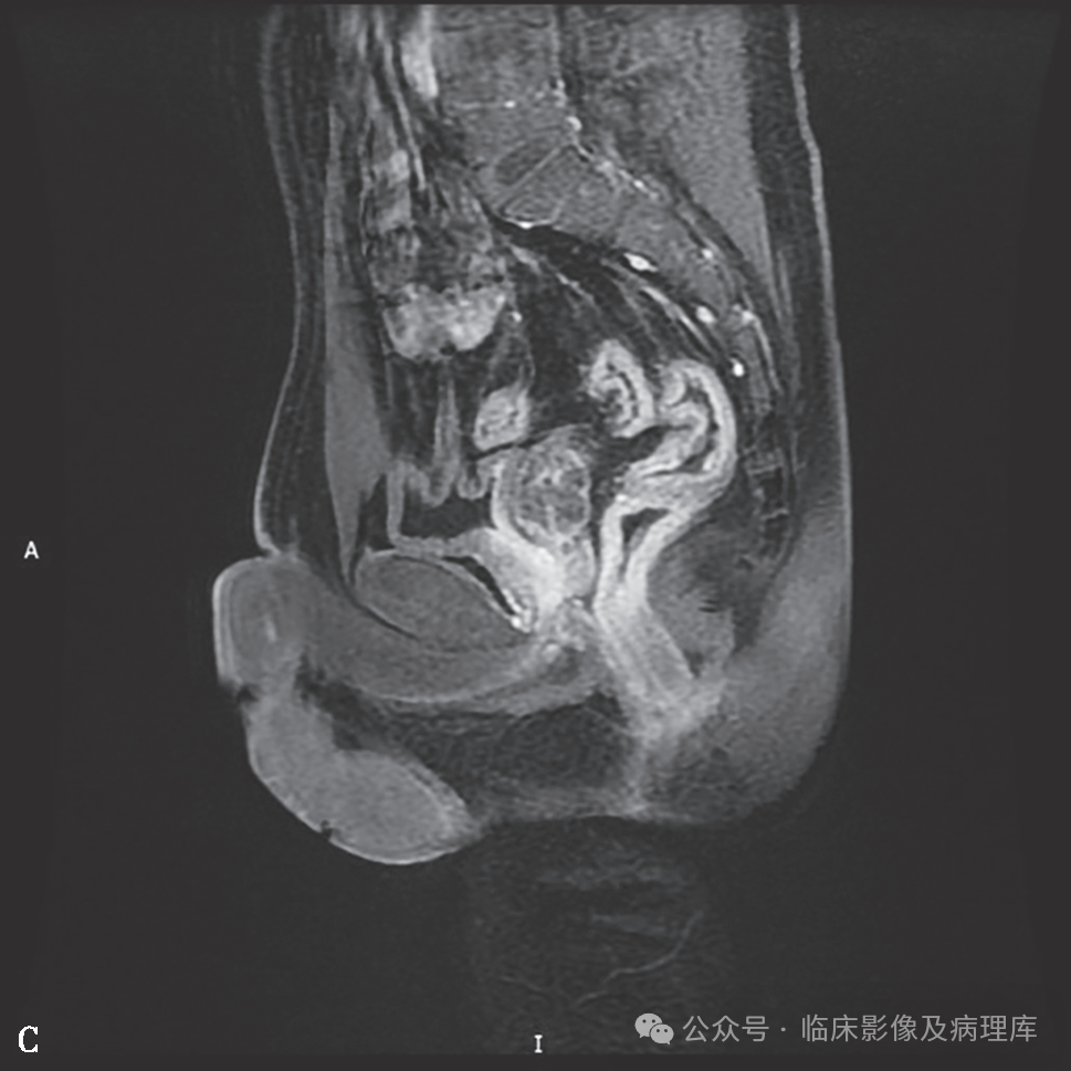 影像PPT - 肛周脓肿与肛瘘-10 影像PPT - 肛周脓肿与肛瘘-10