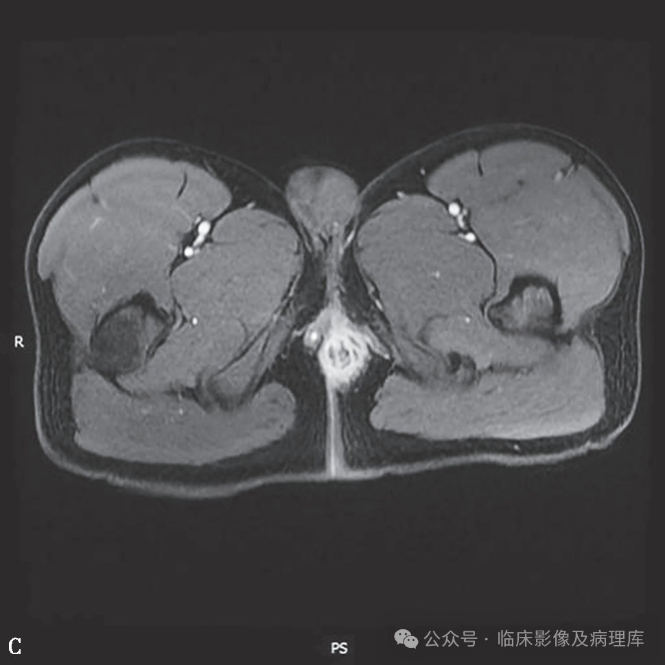 影像PPT - 肛周脓肿与肛瘘-12 影像PPT - 肛周脓肿与肛瘘-12