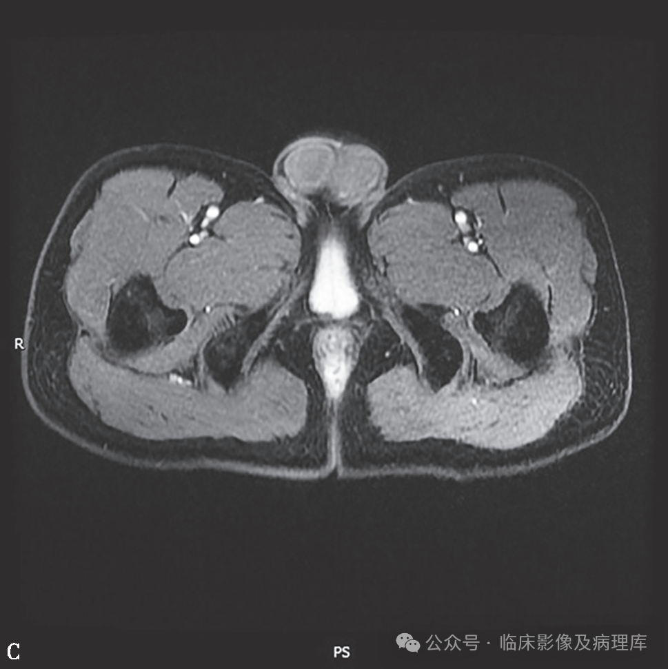 影像PPT - 肛周脓肿与肛瘘-15 影像PPT - 肛周脓肿与肛瘘-15