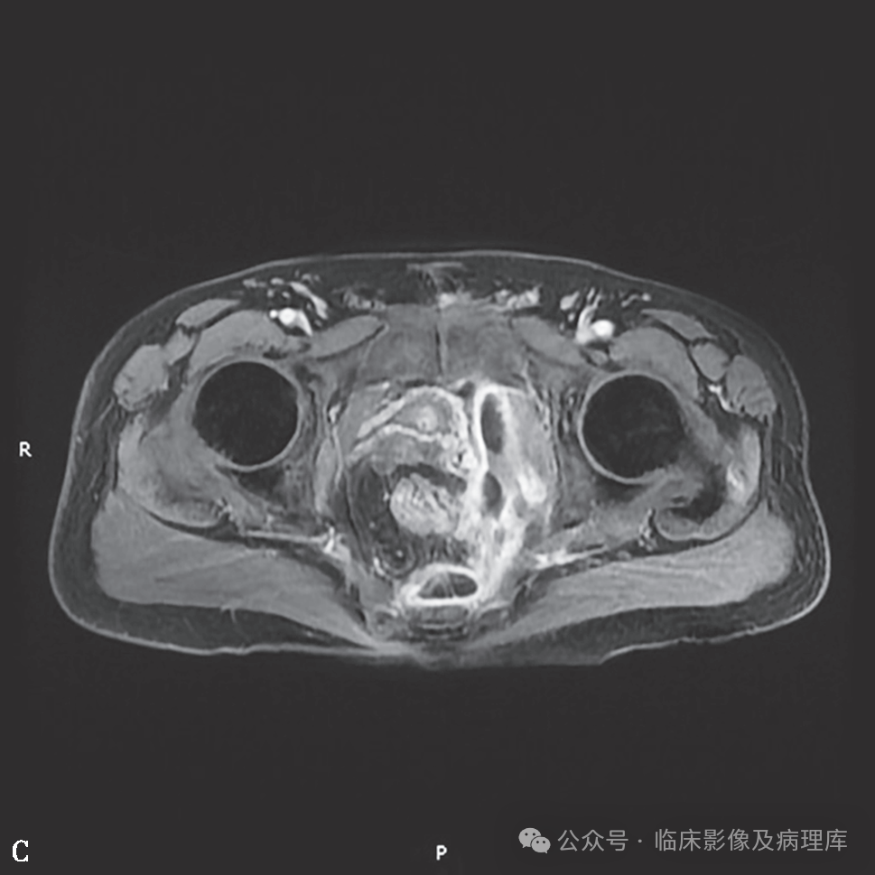影像PPT - 肛周脓肿与肛瘘-21 影像PPT - 肛周脓肿与肛瘘-21