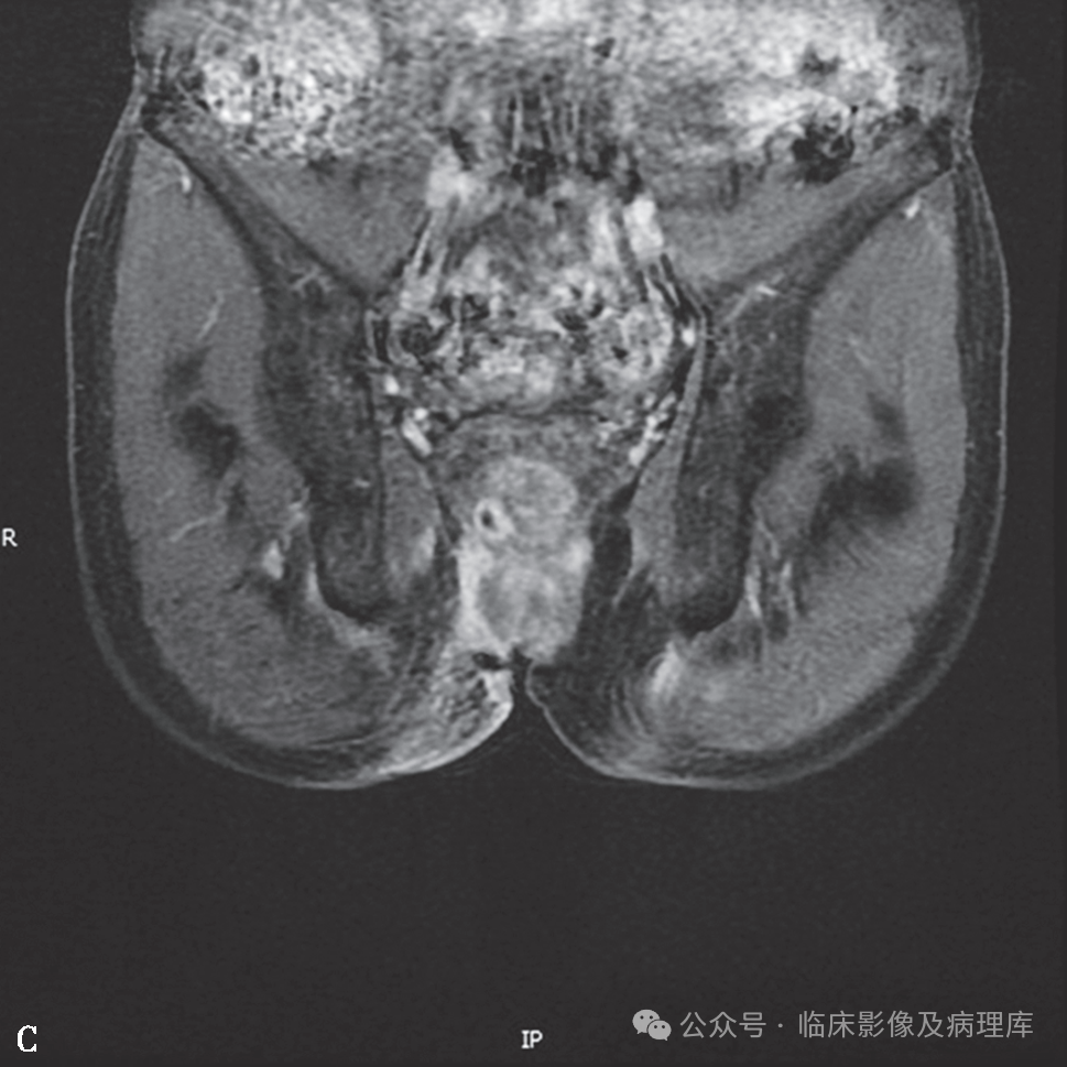影像PPT - 肛周脓肿与肛瘘-1 影像PPT - 肛周脓肿与肛瘘-1