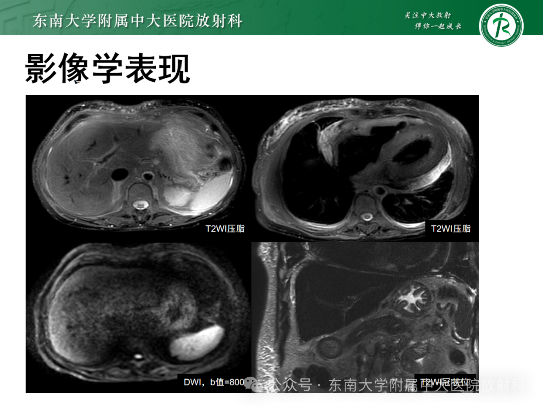 影像PPT - 【PPT】Glisson鞘水肿-5 影像PPT - 【PPT】Glisson鞘水肿-5