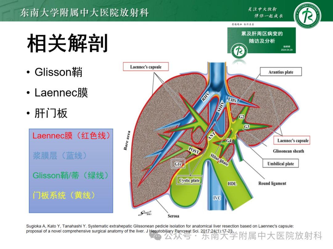影像PPT - 【PPT】Glisson鞘水肿-9 影像PPT - 【PPT】Glisson鞘水肿-9