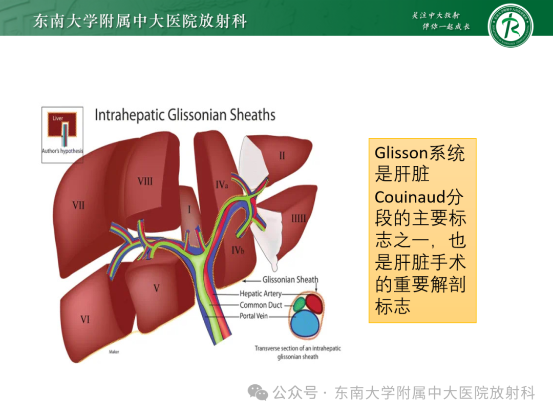 影像PPT - 【PPT】Glisson鞘水肿-11 影像PPT - 【PPT】Glisson鞘水肿-11