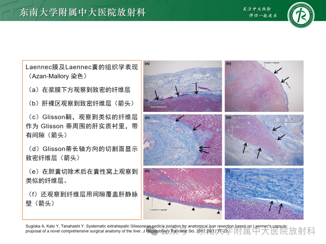 影像PPT - 【PPT】Glisson鞘水肿-13 影像PPT - 【PPT】Glisson鞘水肿-13