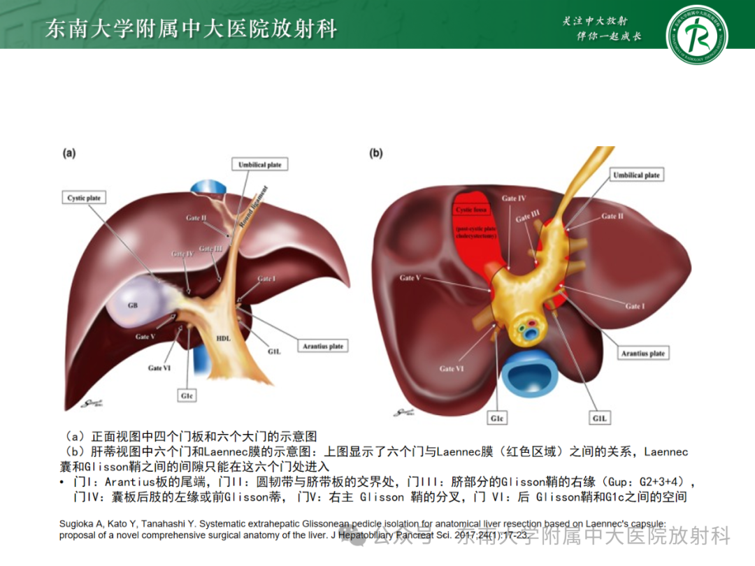 影像PPT - 【PPT】Glisson鞘水肿-15 影像PPT - 【PPT】Glisson鞘水肿-15