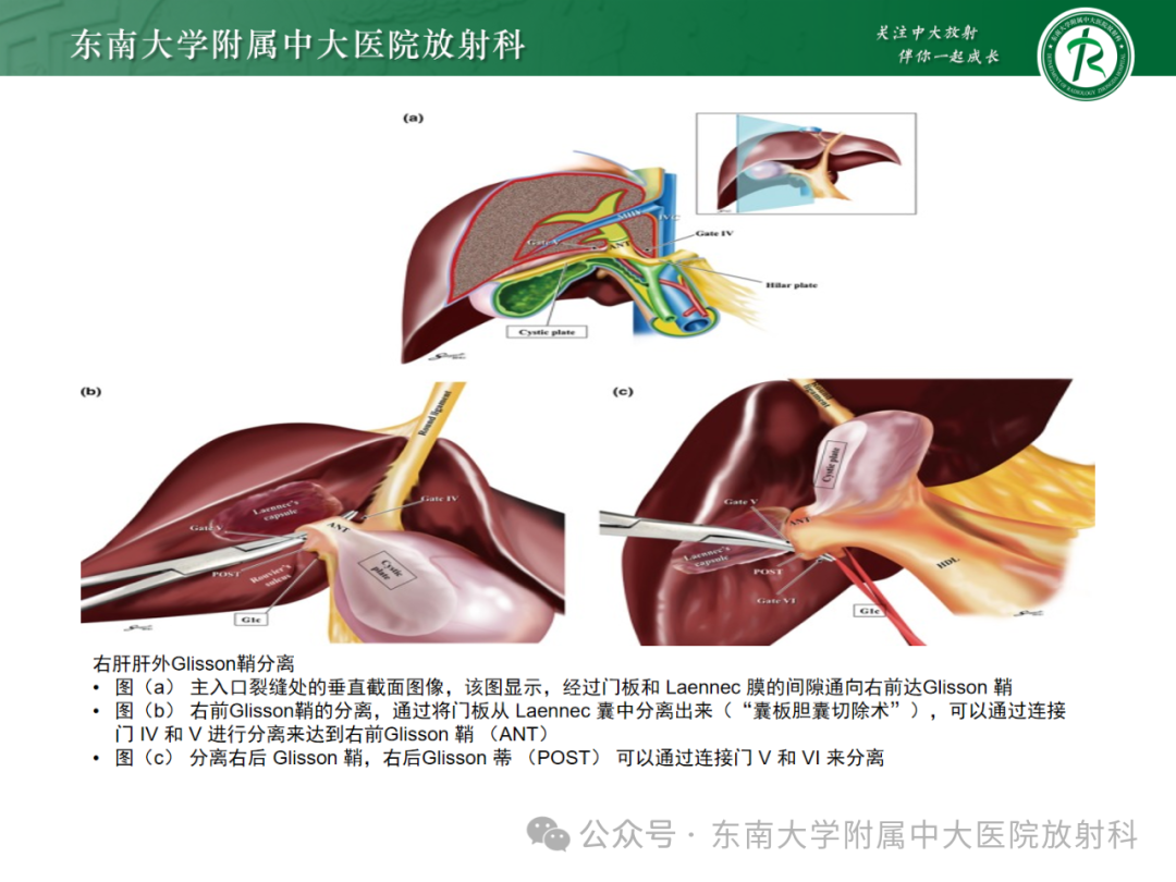 影像PPT - 【PPT】Glisson鞘水肿-16 影像PPT - 【PPT】Glisson鞘水肿-16