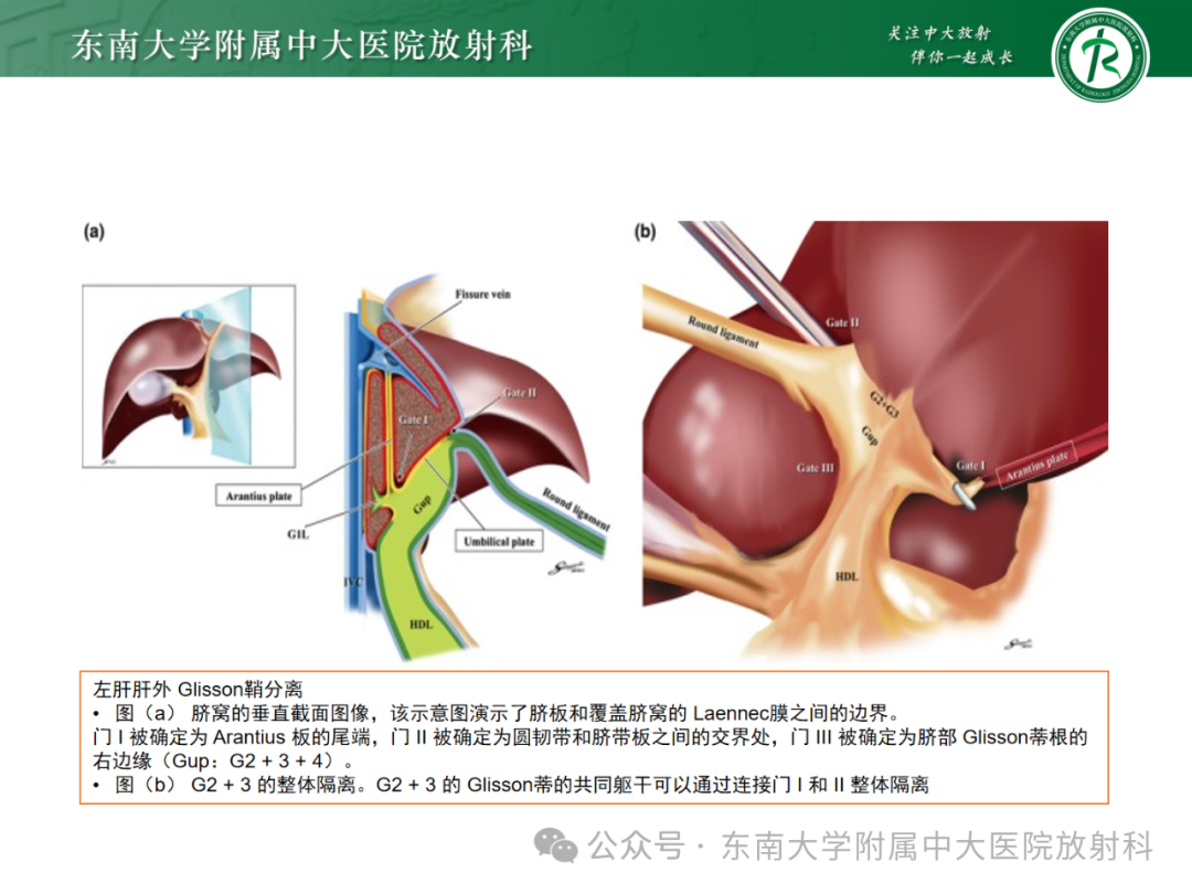 影像PPT - 【PPT】Glisson鞘水肿-17 影像PPT - 【PPT】Glisson鞘水肿-17