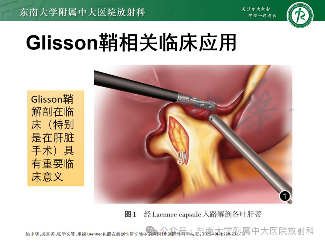 影像PPT - 【PPT】Glisson鞘水肿-19 影像PPT - 【PPT】Glisson鞘水肿-19
