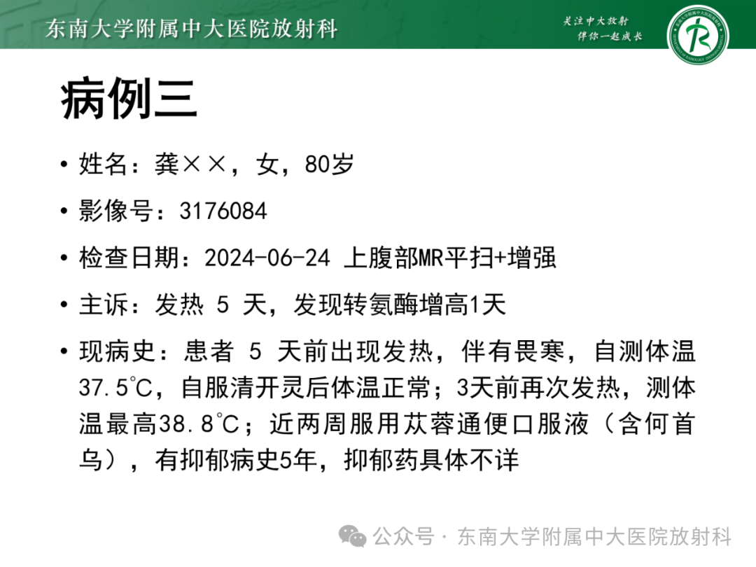 影像PPT - 【PPT】Glisson鞘水肿-22 影像PPT - 【PPT】Glisson鞘水肿-22