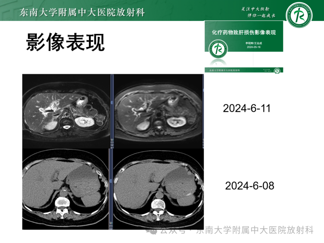 影像PPT - 【PPT】Glisson鞘水肿-23 影像PPT - 【PPT】Glisson鞘水肿-23
