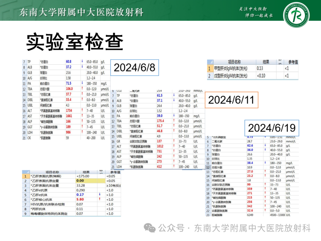影像PPT - 【PPT】Glisson鞘水肿-24 影像PPT - 【PPT】Glisson鞘水肿-24