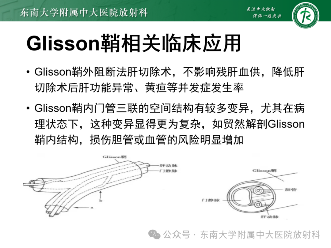 影像PPT - 【PPT】Glisson鞘水肿-20 影像PPT - 【PPT】Glisson鞘水肿-20