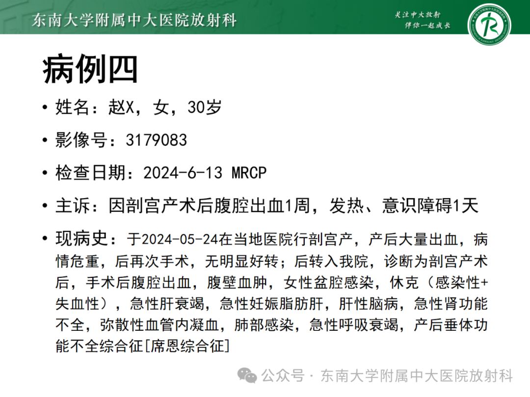 影像PPT - 【PPT】Glisson鞘水肿-25 影像PPT - 【PPT】Glisson鞘水肿-25