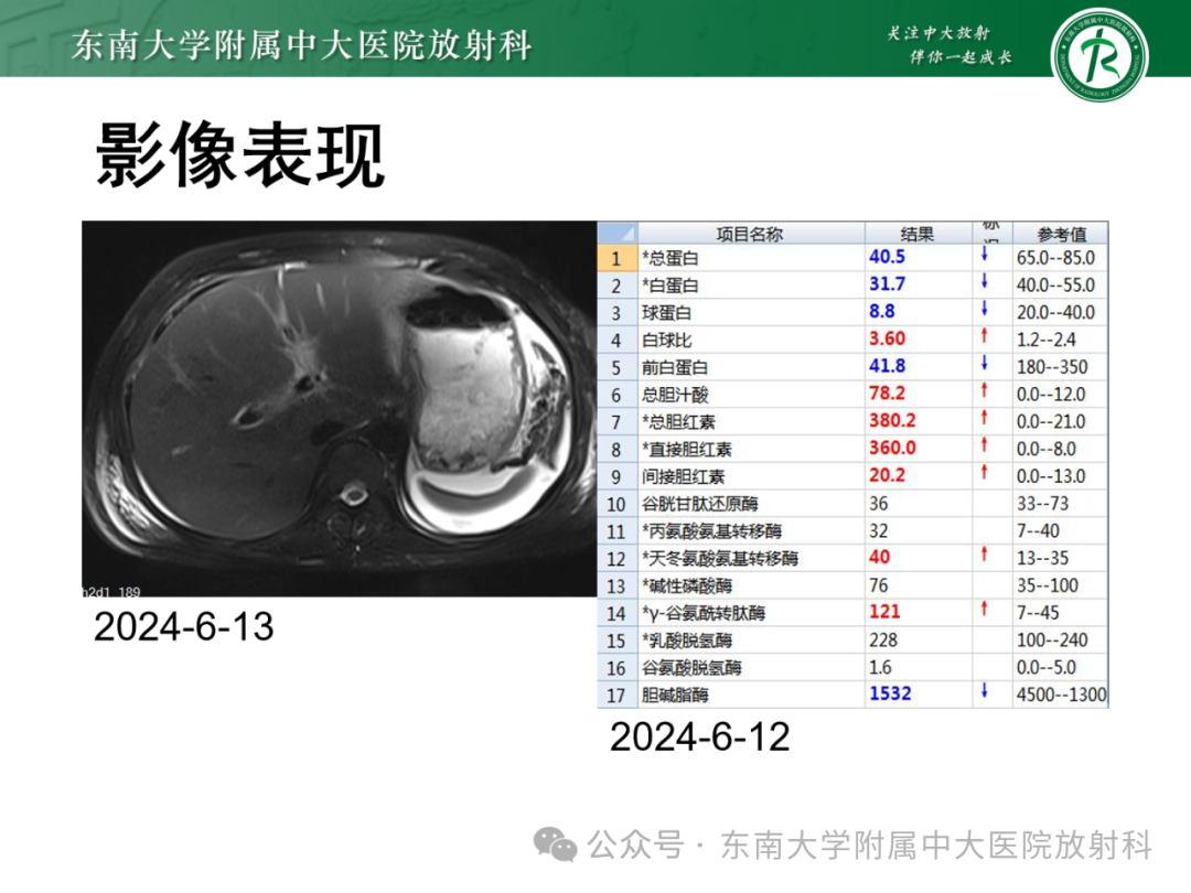 影像PPT - 【PPT】Glisson鞘水肿-26 影像PPT - 【PPT】Glisson鞘水肿-26