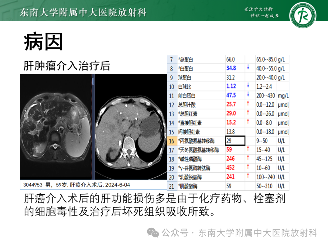 影像PPT - 【PPT】Glisson鞘水肿-28 影像PPT - 【PPT】Glisson鞘水肿-28