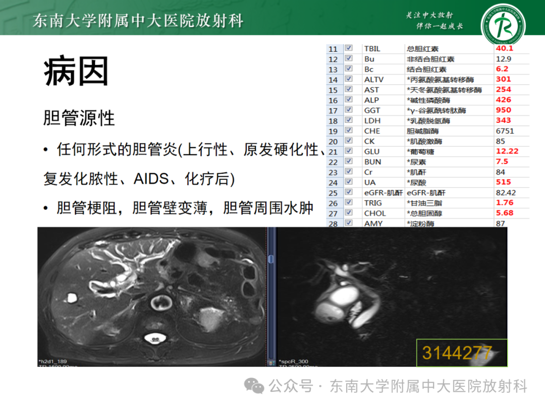 影像PPT - 【PPT】Glisson鞘水肿-29 影像PPT - 【PPT】Glisson鞘水肿-29