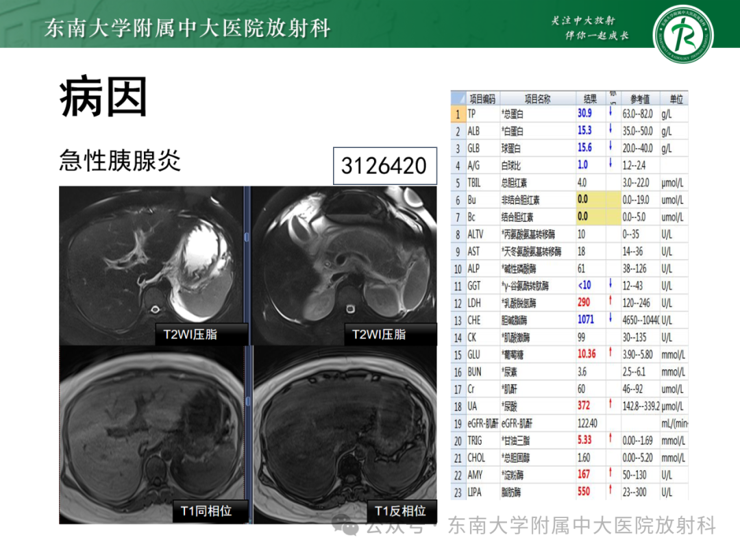 影像PPT - 【PPT】Glisson鞘水肿-30 影像PPT - 【PPT】Glisson鞘水肿-30