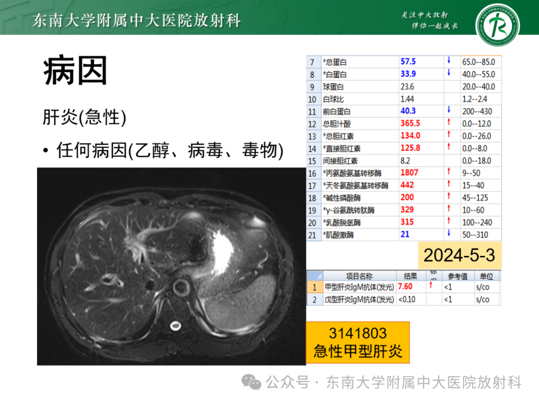 影像PPT - 【PPT】Glisson鞘水肿-31 影像PPT - 【PPT】Glisson鞘水肿-31