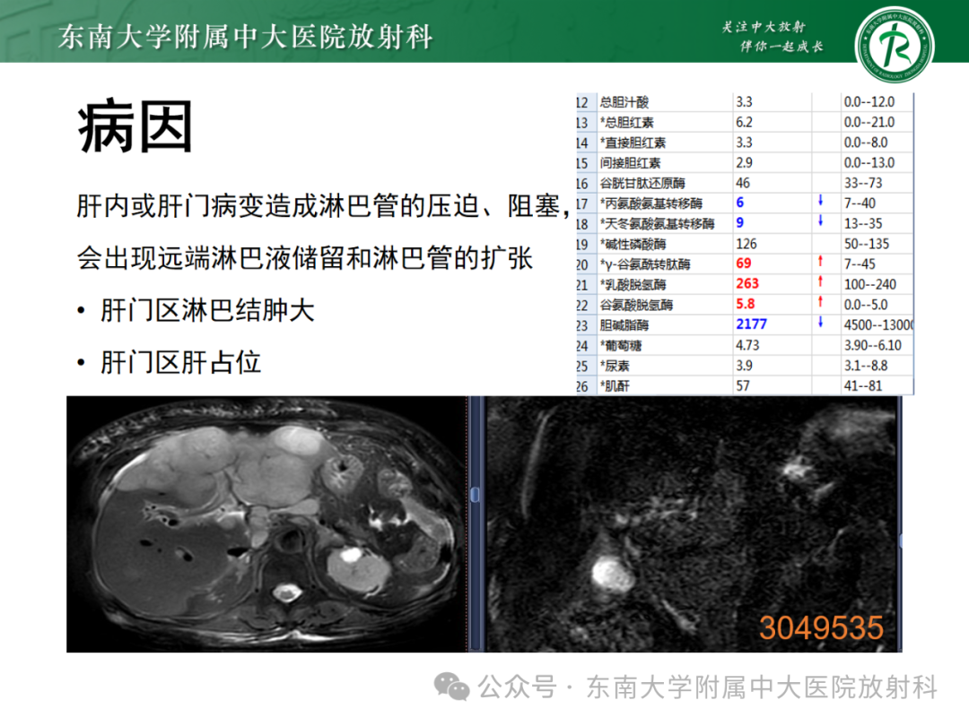 影像PPT - 【PPT】Glisson鞘水肿-32 影像PPT - 【PPT】Glisson鞘水肿-32