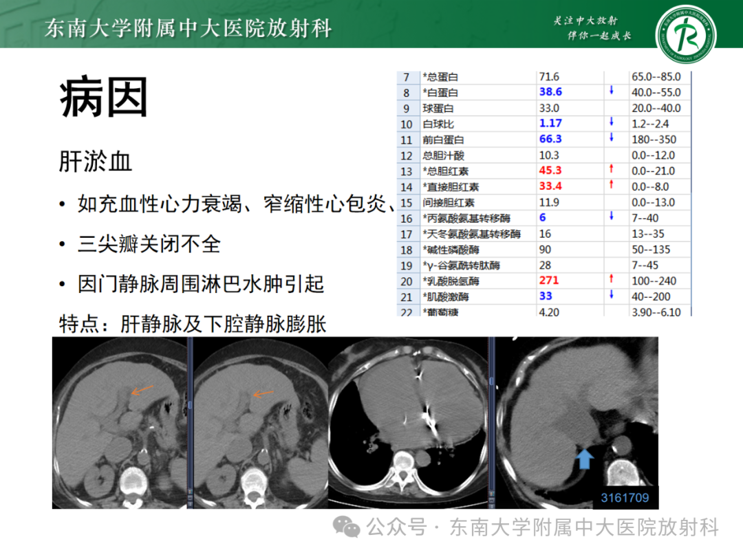 影像PPT - 【PPT】Glisson鞘水肿-33 影像PPT - 【PPT】Glisson鞘水肿-33