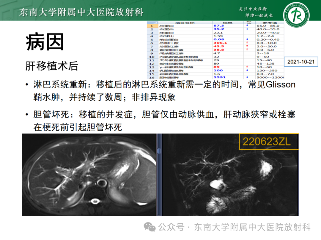 影像PPT - 【PPT】Glisson鞘水肿-35 影像PPT - 【PPT】Glisson鞘水肿-35