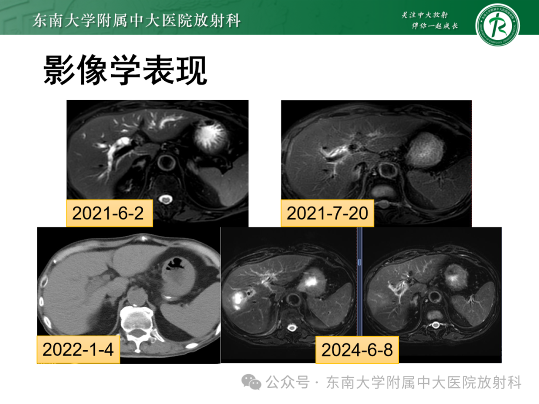 影像PPT - 【PPT】Glisson鞘水肿-37 影像PPT - 【PPT】Glisson鞘水肿-37