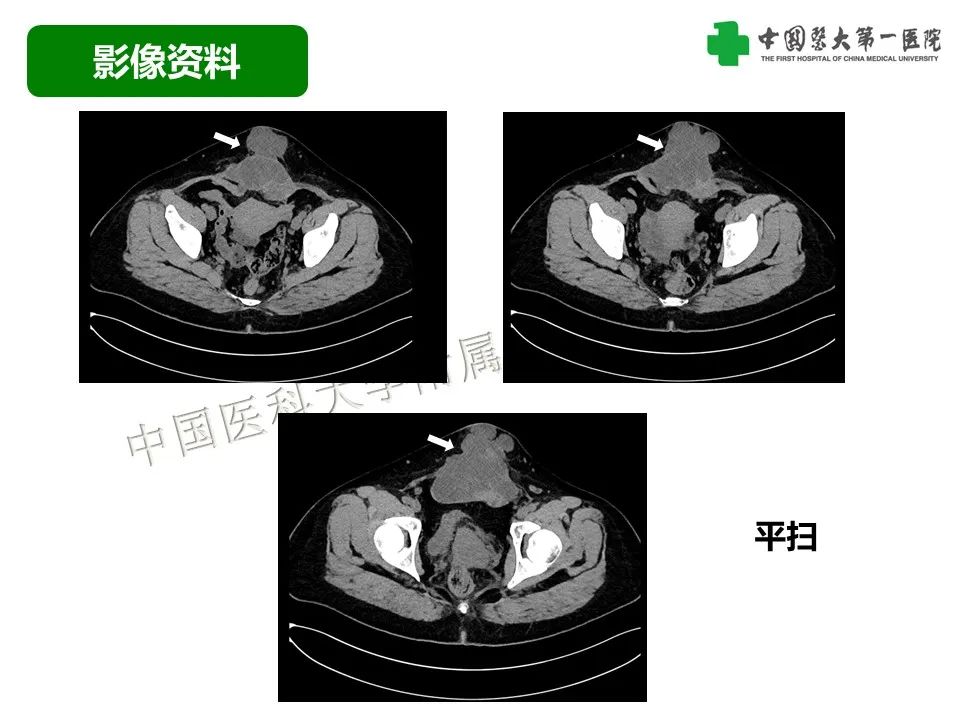 影像PPT - 【病例】腹壁子宫内膜异位症恶变-透明细胞癌-4