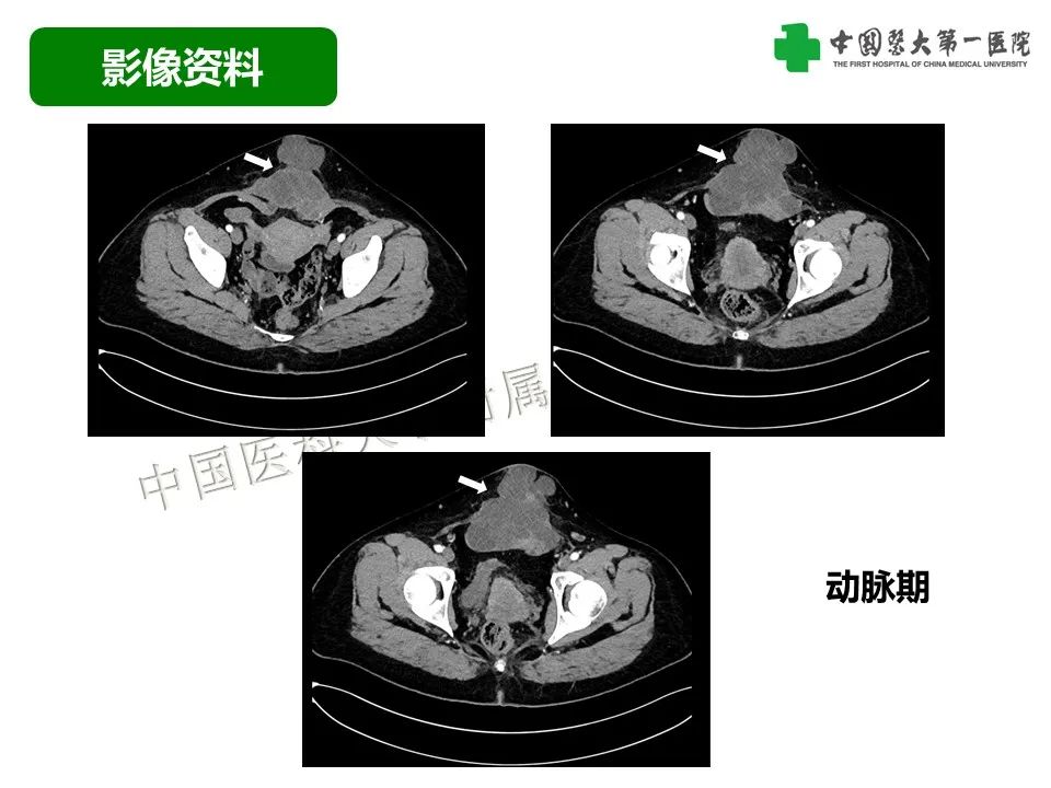 影像PPT - 【病例】腹壁子宫内膜异位症恶变-透明细胞癌-5